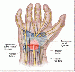 carpal-tunnel-syndrome