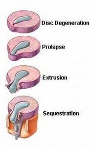 herniated-disc
