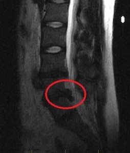 MRI